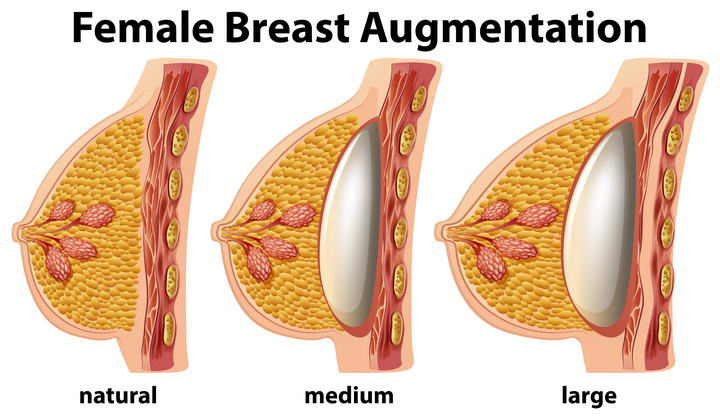 女性乳房隆胸手术解剖示意图免扣图片素材