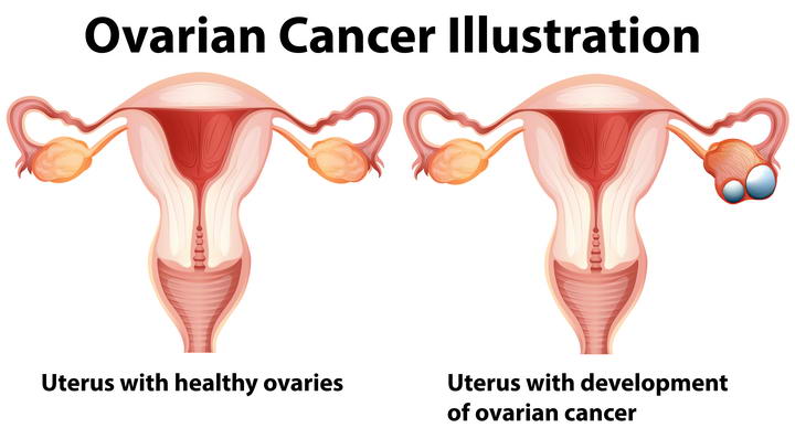 卵巢囊肿卵巢癌人体组织器官解剖图免扣图片素材