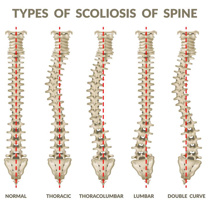 5种不同形态的脊椎弯曲脊柱图片免抠素材