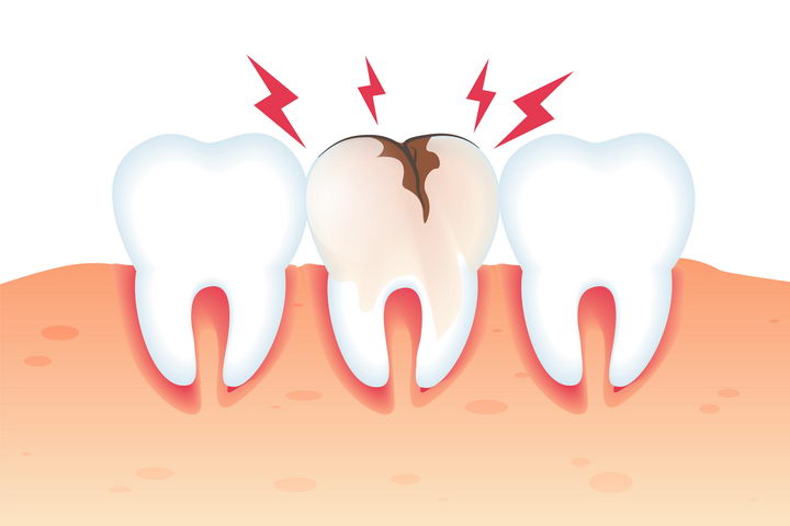 牙齿破裂示意图牙科牙齿保健免抠矢量图片素材