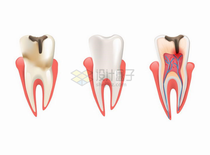 龋齿蛀牙龋洞解剖图牙齿保健png图片免抠矢量素材 健康医疗-第1张
