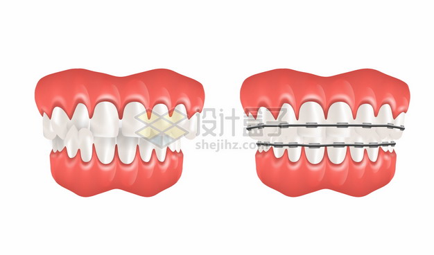 牙周炎和牙齿矫正器牙科png图片素材 设计盒子