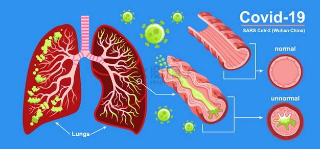 新型冠状病毒对人体肺部的影响插画png图片素材