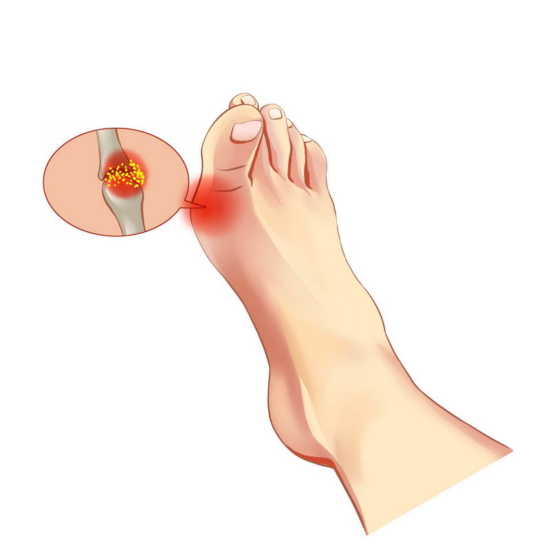脚指头疼类风湿性关节炎8196301免抠图片素材 健康医疗-第1张