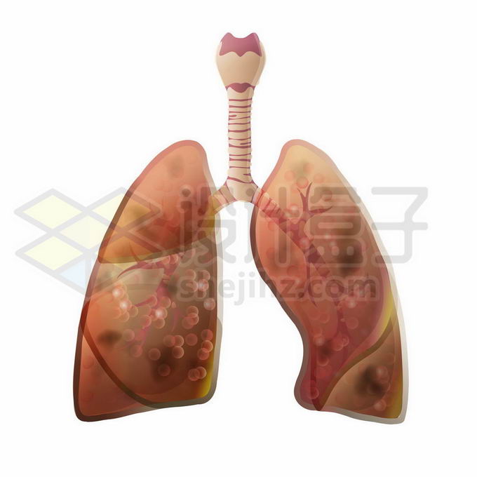 患病肺癌肿瘤肺部人体呼吸系统人体器官7354391矢量图片免抠素材 健康医疗-第1张
