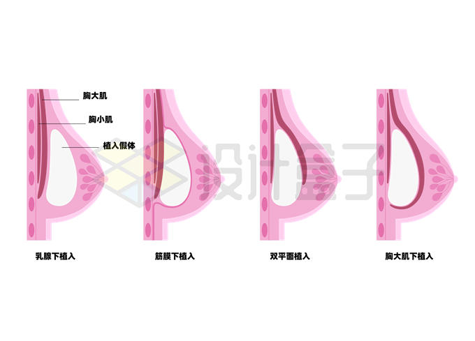 淡紫色假体隆胸手术女性乳房内部结构解剖图1238311矢量图片免抠素材 健康医疗-第1张