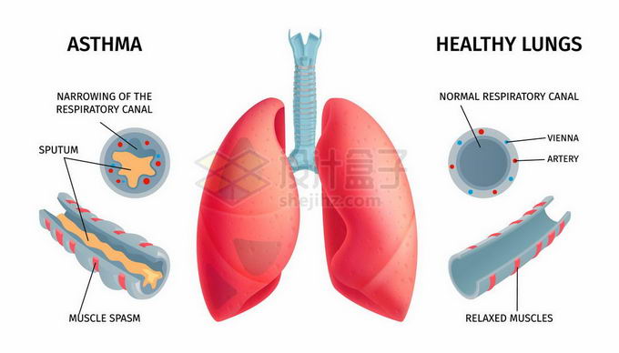 健康和生病的肺部肌肉痉挛人体器官组织5674835矢量图片免抠素材 健康医疗-第1张