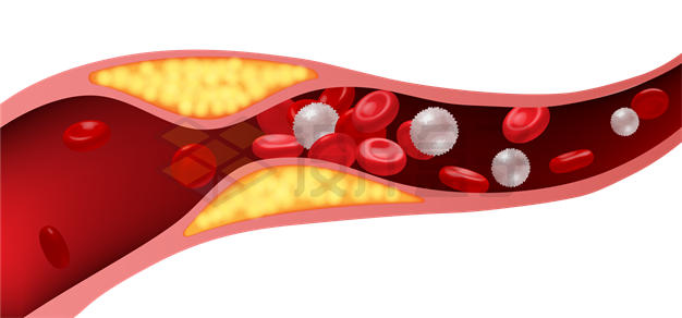 血管中的白细胞和红细胞血栓示意图9813529矢量图片免抠素材 健康医疗-第1张