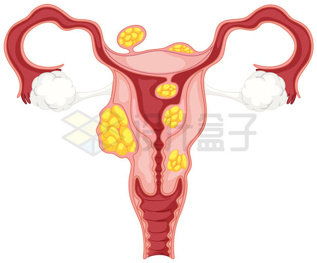 子宫肌瘤内部结构示意图6636035矢量图片免抠素材 健康医疗-第1张