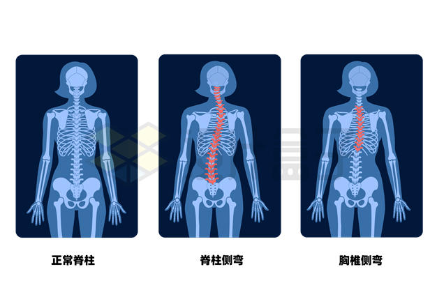 人体胸椎脊柱侧弯X光透视示意图5324997矢量图片免抠素材 健康医疗-第1张