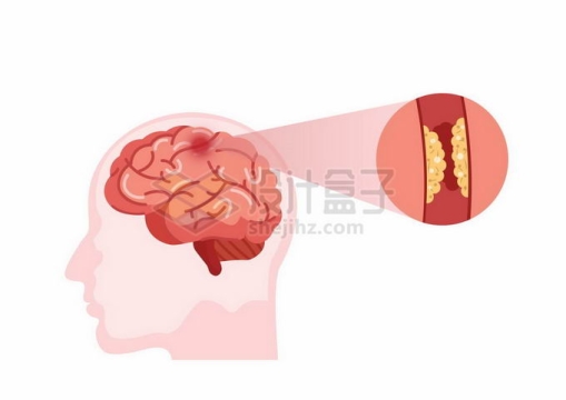 人体大脑中的脑血栓脑部疾病1192282矢量图片免抠素材