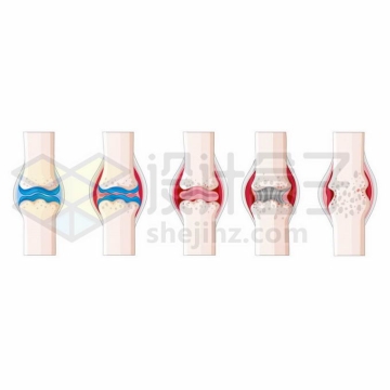 类风湿关节炎的5个不同阶段骨关节炎示意图6376735矢量图片免抠素材