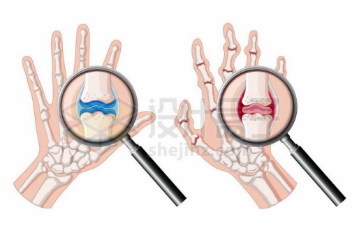 放大镜下的手部类风湿关节炎人体骨骼示意图4018822矢量图片免抠素材