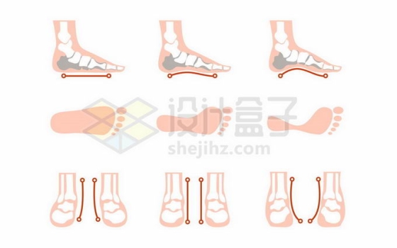 足部病例扁平足高弓足脚部骨骼示意图5038306矢量图片免抠素材