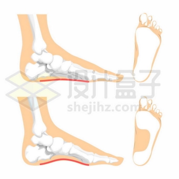 足部病例扁平足和正常脚部骨骼示意图7526910矢量图片免抠素材