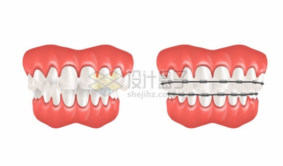 牙周炎和牙齿矫正器牙科png图片素材