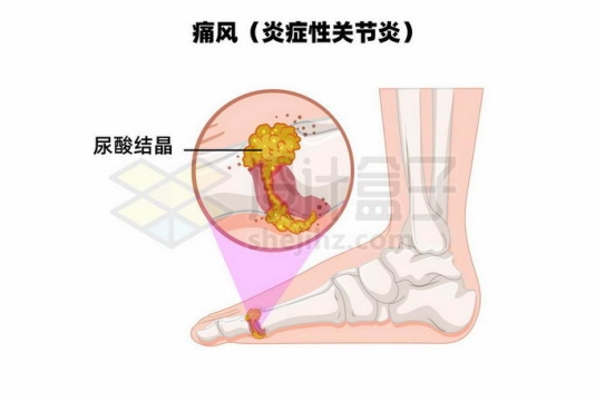 痛风炎症性关节炎人体脚骨解剖图尿酸结晶6585791矢量图片免抠素材