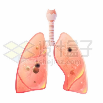 患病肺癌肿瘤肺部人体呼吸系统人体器官5094219矢量图片免抠素材