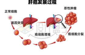 肝脏从正常发展成恶性肿瘤肝癌发展过程示意图4377522矢量图片免抠素材