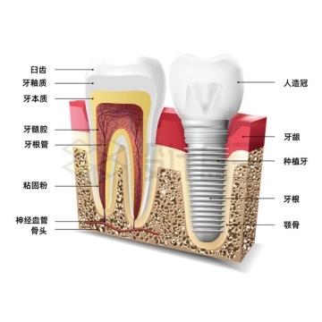牙齿内部结构解剖图和假牙植牙示意图4149175矢量图片免抠素材