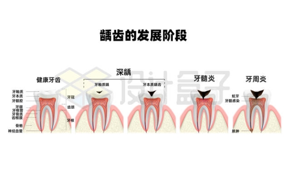 牙齿蛀牙龋齿的发展阶段9705011矢量图片免抠素材