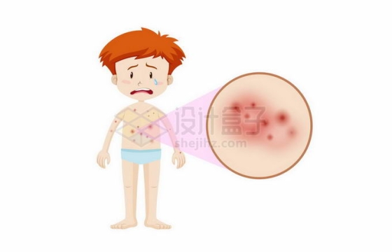 卡通男孩皮肤上的红疹子过敏症8229128矢量图片免抠素材