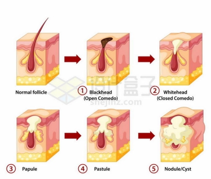 人体皮肤结构毛囊脓包囊肿等病变过程7589457矢量图片免抠素材