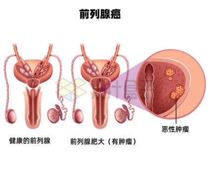 前列腺癌男性生殖疾病内部结构示意图1733340矢量图片免抠素材