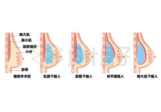 假体隆胸手术女性乳房内部结构解剖图7872553矢量图片免抠素材