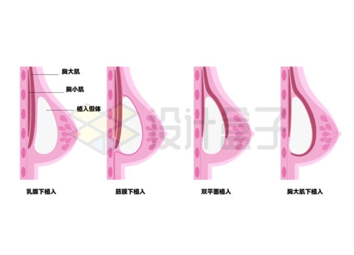 淡紫色假体隆胸手术女性乳房内部结构解剖图1238311矢量图片免抠素材