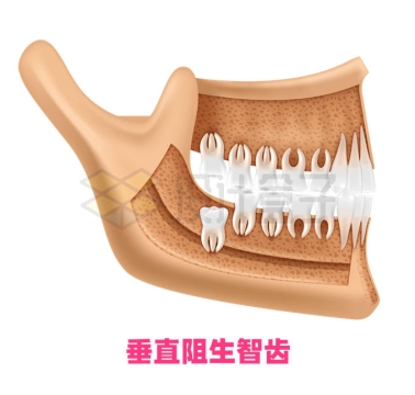 垂直阻生智齿牙齿内部结构示意图8548613矢量图片免抠素材