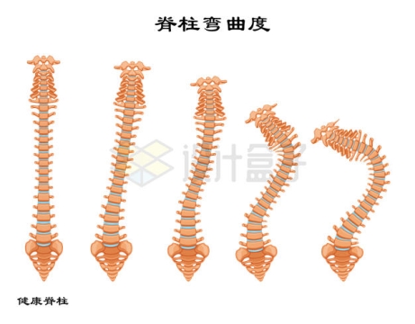 5种不同程度的脊柱弯曲度脊柱侧弯7216131矢量图片免抠素材
