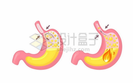 卡通人体胃部内部结构胃酸胃气胀胃难受胃上火3181064矢量图片免费下载