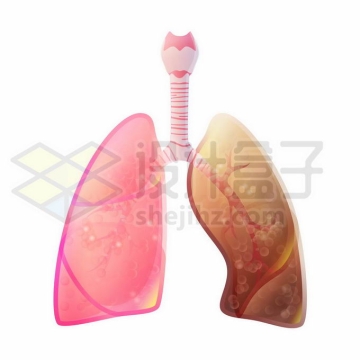 开始患病的肺部人体呼吸系统人体器官1850680矢量图片免抠素材