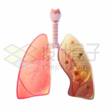 患病的肺癌肺部人体呼吸系统人体器官1476305矢量图片免抠素材