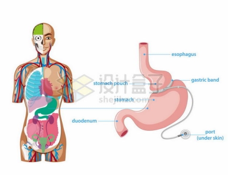人体器官组织结构解剖图和胃部胃束带手术8661539矢量图片免抠素材