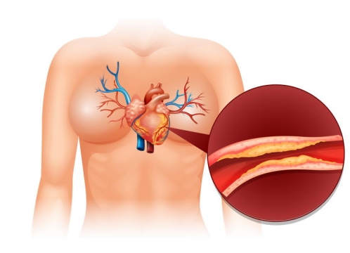 心肌梗塞人体心脏解剖图疾病健康配图图片免抠素材