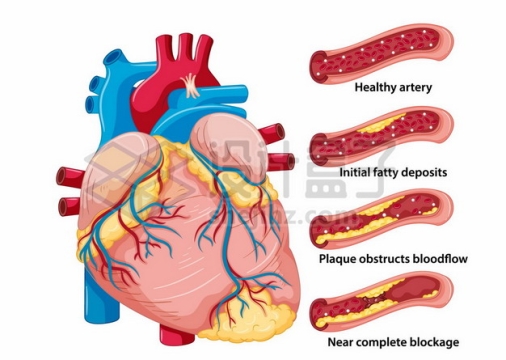 心脏和血管脂肪堆积心血管疾病人体器官组织921002png矢量图片素材