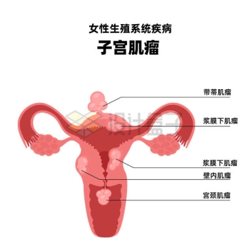 子宫肌瘤女性生殖系统疾病示意图7001069矢量图片免抠素材