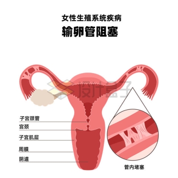 输卵管阻塞女性生殖系统疾病示意图8010412矢量图片免抠素材