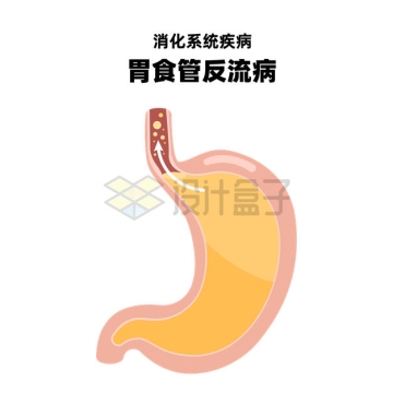 胃食管反流病消化系统疾病示意图6539905矢量图片免抠素材