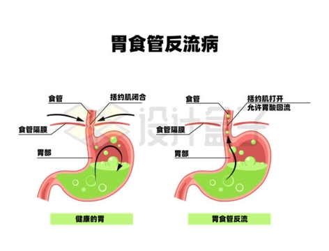 胃部内部结构胃食管反流病示意图4054677矢量图片免抠素材