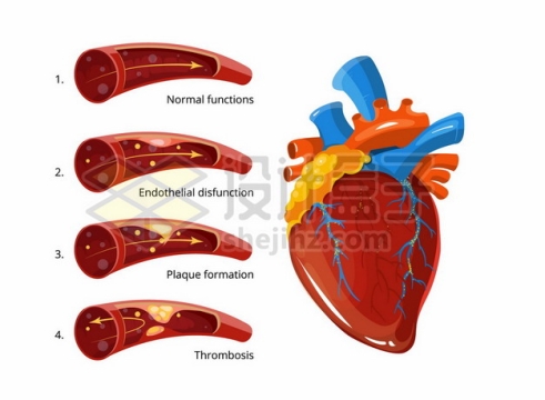 心脏和血管血栓形成过程示意图206672png矢量图片素材