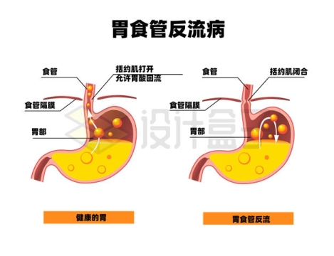 胃部内部结构胃食管反流病示意图6588610矢量图片免抠素材
