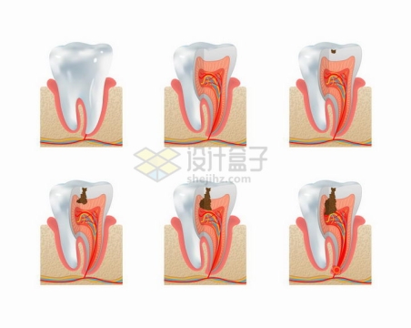 龋齿蛀牙龋洞发育流程图牙齿保健png图片免抠矢量素材