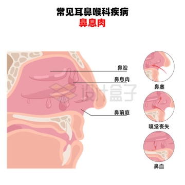 鼻息肉内部结构解剖图常见耳喉鼻科疾病4347133矢量图片免抠素材