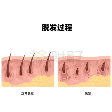 脱发的过程解剖图常见皮肤病6144966矢量图片免抠素材