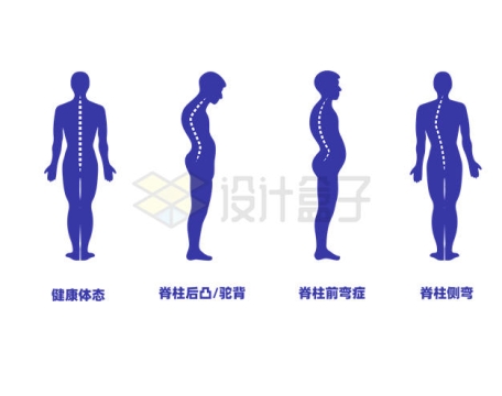 脊柱后凸/驼背/脊椎前弯症/脊柱侧弯等不健康体态人体模型2495516矢量图片免抠素材