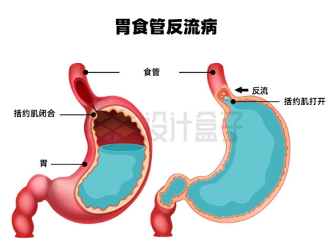胃食管反流病胃部结构示意图7845625矢量图片免抠素材