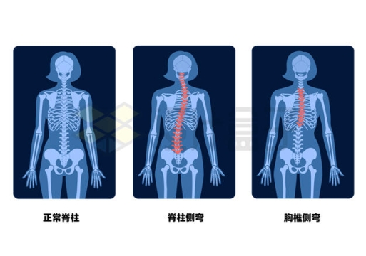 人体胸椎脊柱侧弯X光透视示意图5324997矢量图片免抠素材
